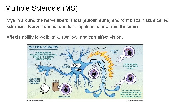 Multiple Sclerosis (MS) Myelin around the nerve fibers is lost (autoimmune) and forms scar