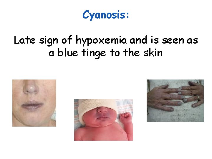 Cyanosis: Late sign of hypoxemia and is seen as a blue tinge to the