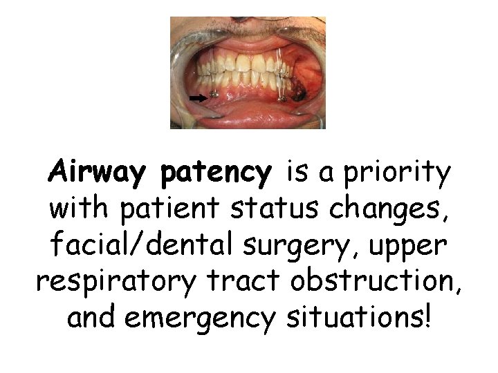 Airway patency is a priority with patient status changes, facial/dental surgery, upper respiratory tract