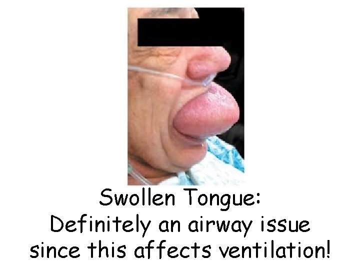 Swollen Tongue: Definitely an airway issue since this affects ventilation! 