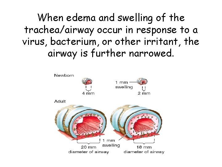 When edema and swelling of the trachea/airway occur in response to a virus, bacterium,