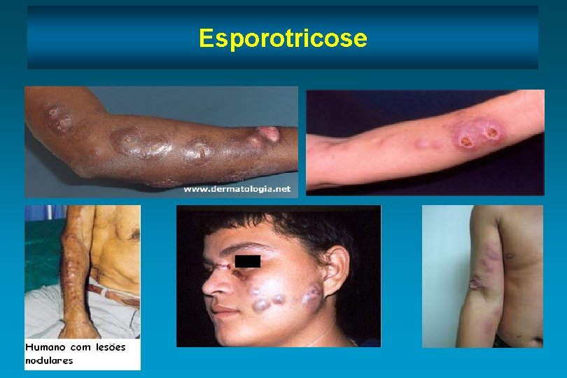 Esporotricose 