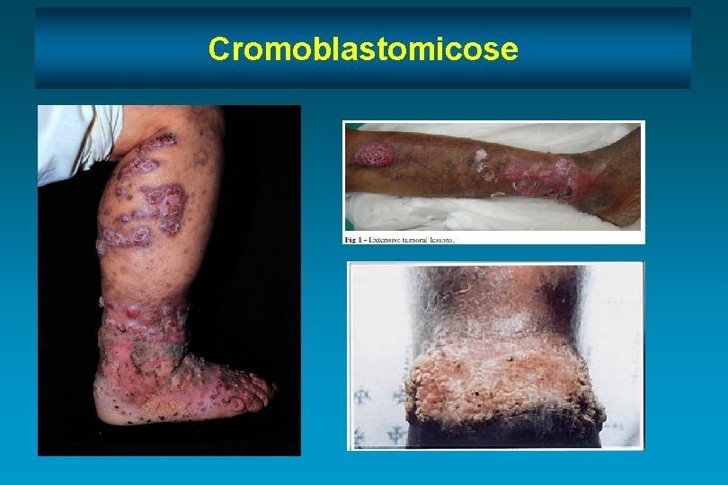 Cromoblastomicose 