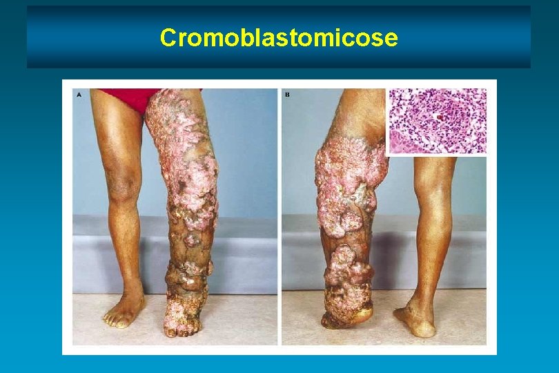 Cromoblastomicose 