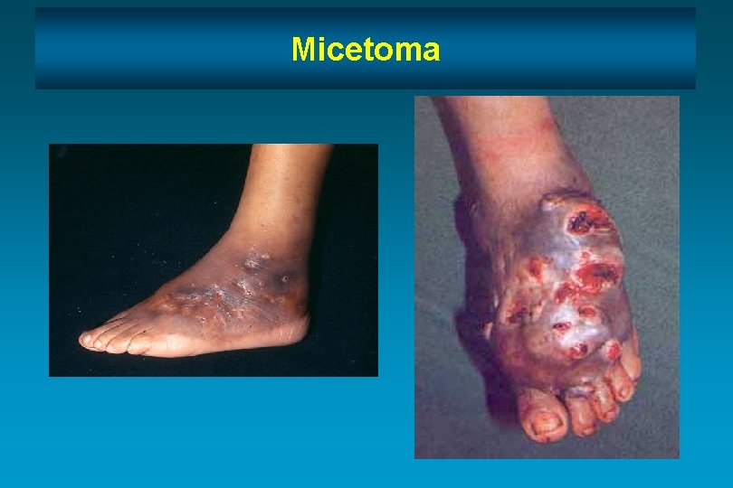 Micetoma 