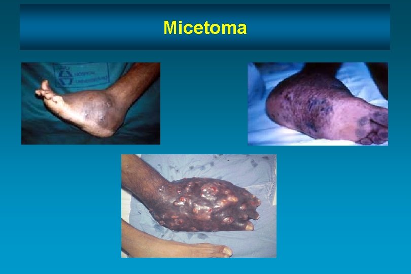 Micetoma 