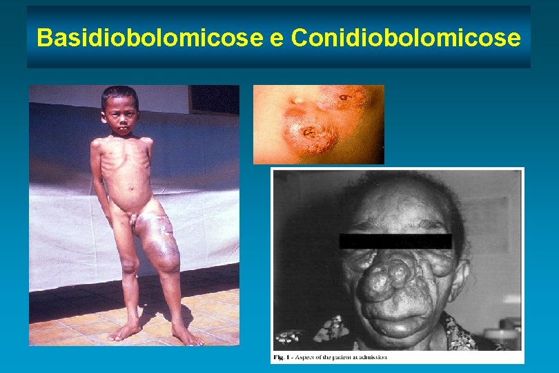 Basidiobolomicose e Conidiobolomicose 