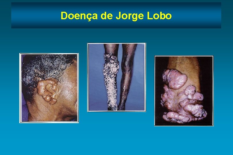 Doença de Jorge Lobo 