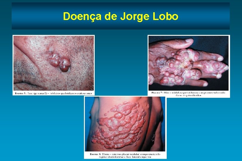Doença de Jorge Lobo 