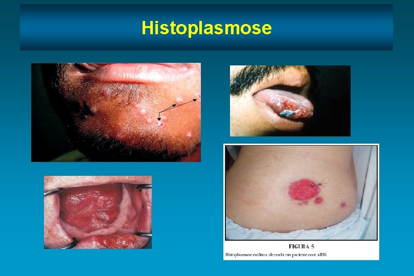 Histoplasmose 