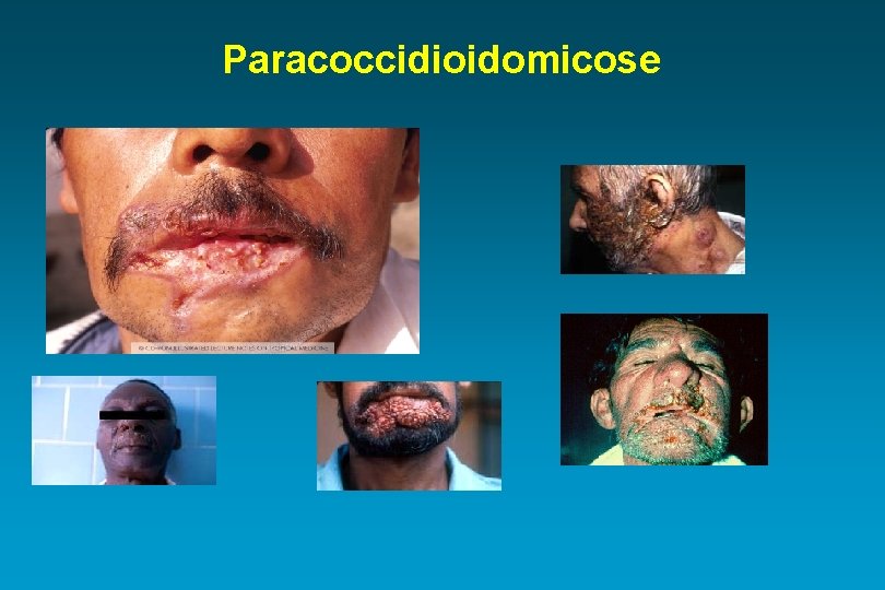 Paracoccidioidomicose 