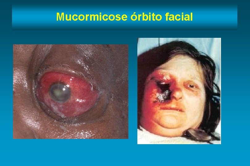 Mucormicose órbito facial 
