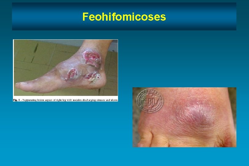 Feohifomicoses 