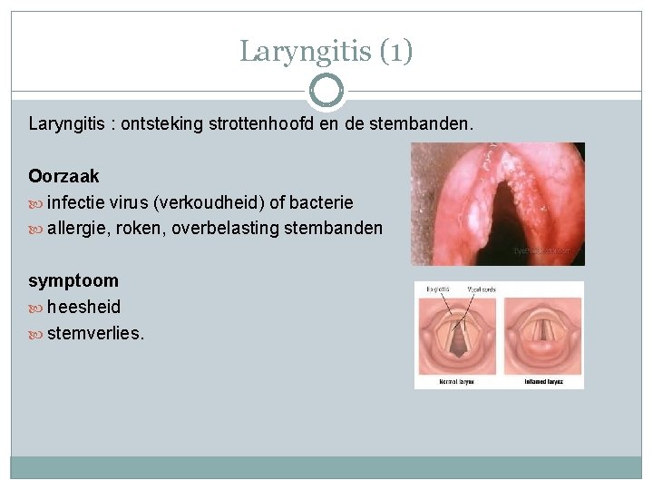 Laryngitis (1) Laryngitis : ontsteking strottenhoofd en de stembanden. Oorzaak infectie virus (verkoudheid) of