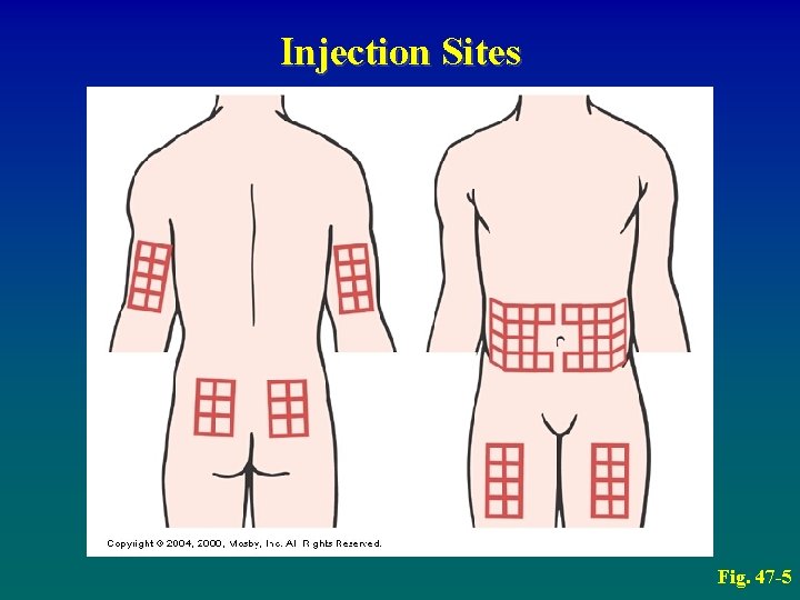 Injection Sites Fig. 47 -5 
