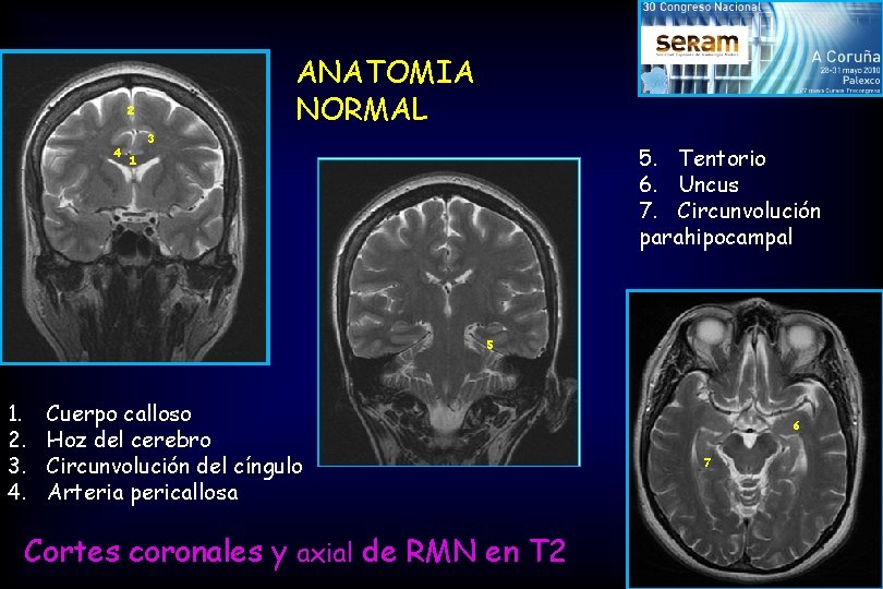 ANATOMIA NORMAL 2 4 3 5. Tentorio 6. Uncus 7. Circunvolución parahipocampal 1 5