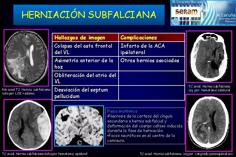 HERNIACIÓN SUBFALCIANA Hallazgos de imagen Complicaciones Colapso del asta frontal del VL Infarto de