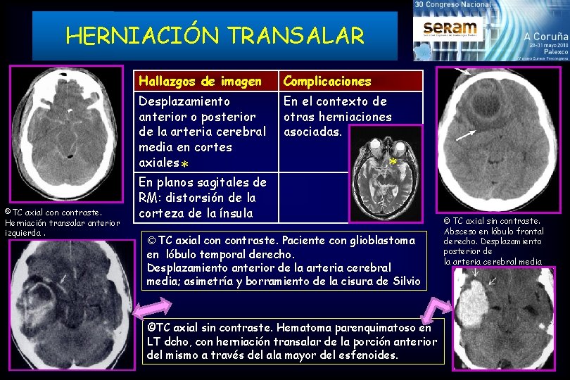 HERNIACIÓN TRANSALAR ©TC axial contraste. Herniación transalar anterior izquierda. Hallazgos de imagen Complicaciones Desplazamiento