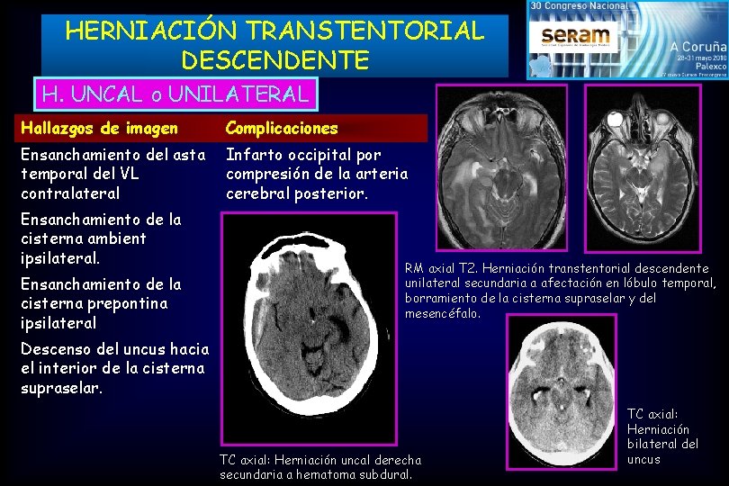 HERNIACIÓN TRANSTENTORIAL DESCENDENTE H. UNCAL o UNILATERAL Hallazgos de imagen Complicaciones Ensanchamiento del asta