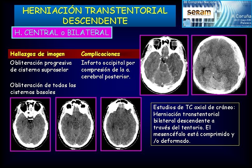 HERNIACIÓN TRANSTENTORIAL DESCENDENTE H. CENTRAL o BILATERAL Hallazgos de imagen Complicaciones Obliteración progresiva de
