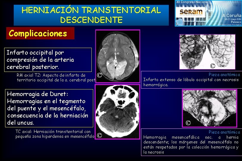 HERNIACIÓN TRANSTENTORIAL DESCENDENTE Complicaciones Infarto occipital por compresión de la arteria cerebral posterior. RM