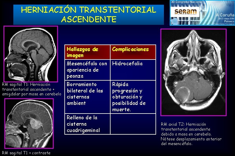 HERNIACIÓN TRANSTENTORIAL ASCENDENTE RM sagital T 1: Herniación transtentorial ascendente + amigdalar por masa