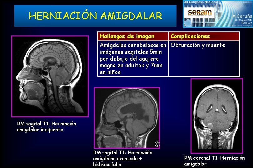 HERNIACIÓN AMIGDALAR Hallazgos de imagen Complicaciones Amígdalas cerebelosas en Obturación y muerte imágenes sagitales