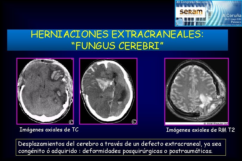 HERNIACIONES EXTRACRANEALES: “FUNGUS CEREBRI” © Imágenes axiales de TC © Imágenes axiales de RM