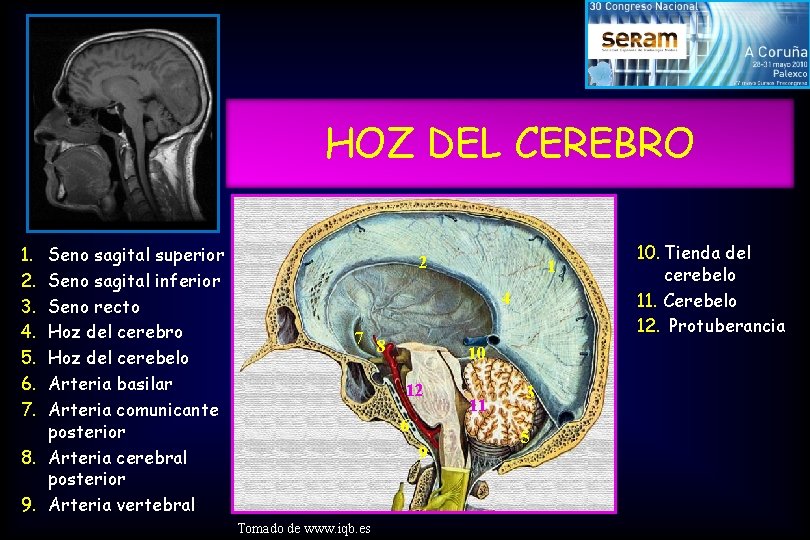 HOZ DEL CEREBRO 1. 2. 3. 4. 5. 6. 7. Seno sagital superior Seno