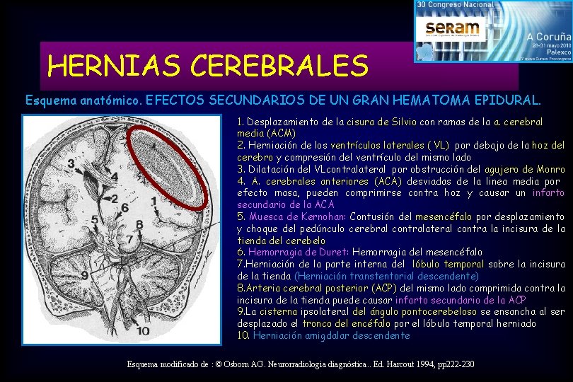 HERNIAS CEREBRALES Esquema anatómico. EFECTOS SECUNDARIOS DE UN GRAN HEMATOMA EPIDURAL. 1. Desplazamiento de