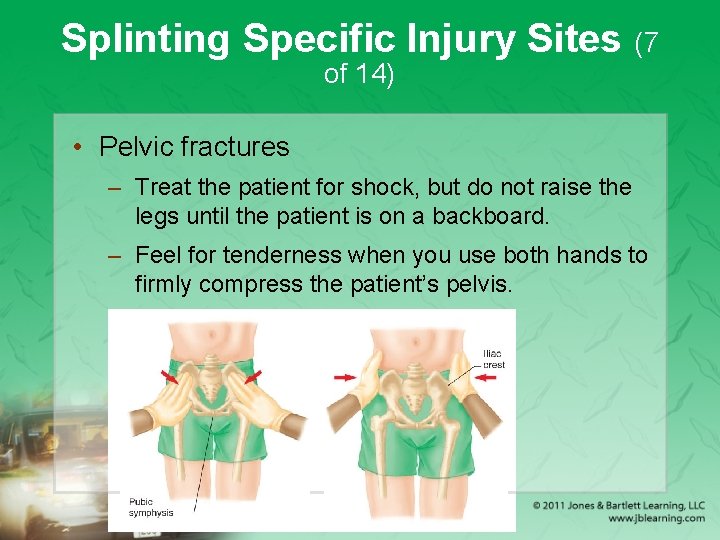 Splinting Specific Injury Sites (7 of 14) • Pelvic fractures – Treat the patient