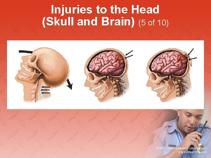 Injuries to the Head (Skull and Brain) (5 of 10) 