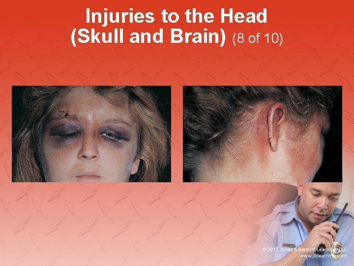 Injuries to the Head (Skull and Brain) (8 of 10) 