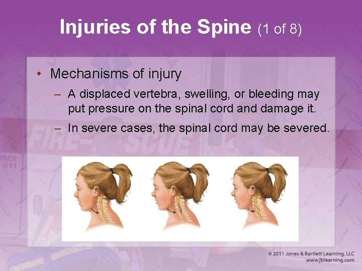 Injuries of the Spine (1 of 8) • Mechanisms of injury – A displaced