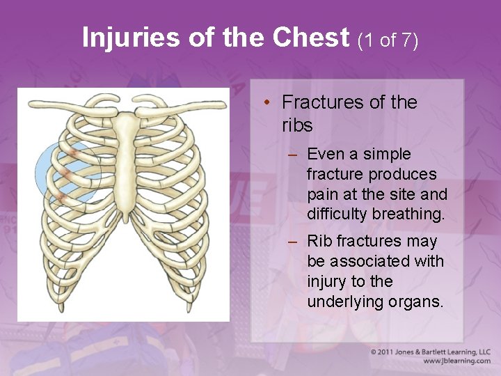 Injuries of the Chest (1 of 7) • Fractures of the ribs – Even