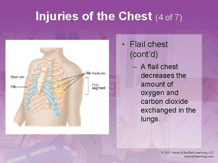 Injuries of the Chest (4 of 7) • Flail chest (cont’d) – A flail