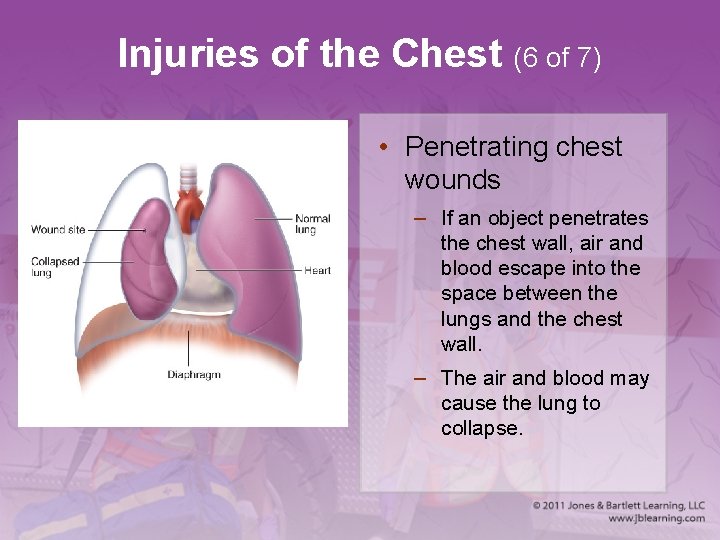 Injuries of the Chest (6 of 7) • Penetrating chest wounds – If an