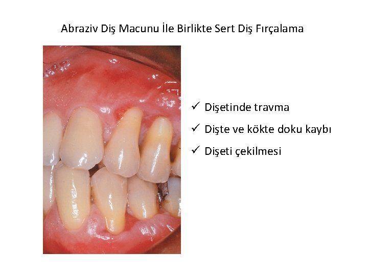 Abraziv Diş Macunu İle Birlikte Sert Diş Fırçalama ü Dişetinde travma ü Dişte ve