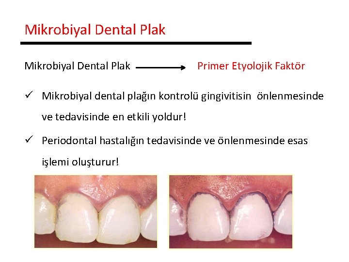 Mikrobiyal Dental Plak Primer Etyolojik Faktör ü Mikrobiyal dental plağın kontrolü gingivitisin önlenmesinde ve