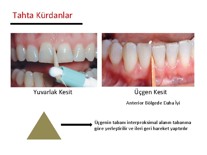 Tahta Kürdanlar Yuvarlak Kesit Üçgen Kesit Anterior Bölgede Daha İyi Üçgenin tabanı interproksimal alanın