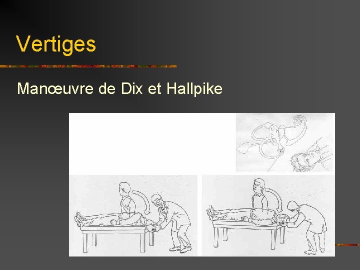 Vertiges Manœuvre de Dix et Hallpike 