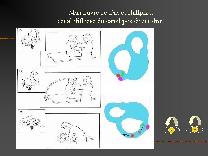 Manœuvre de Dix et Hallpike: canalolithiase du canal postérieur droit 