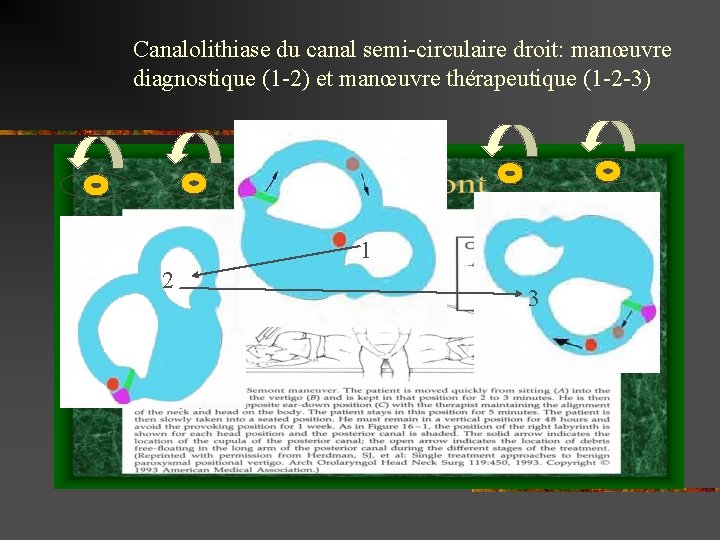 Canalolithiase du canal semi-circulaire droit: manœuvre diagnostique (1 -2) et manœuvre thérapeutique (1 -2