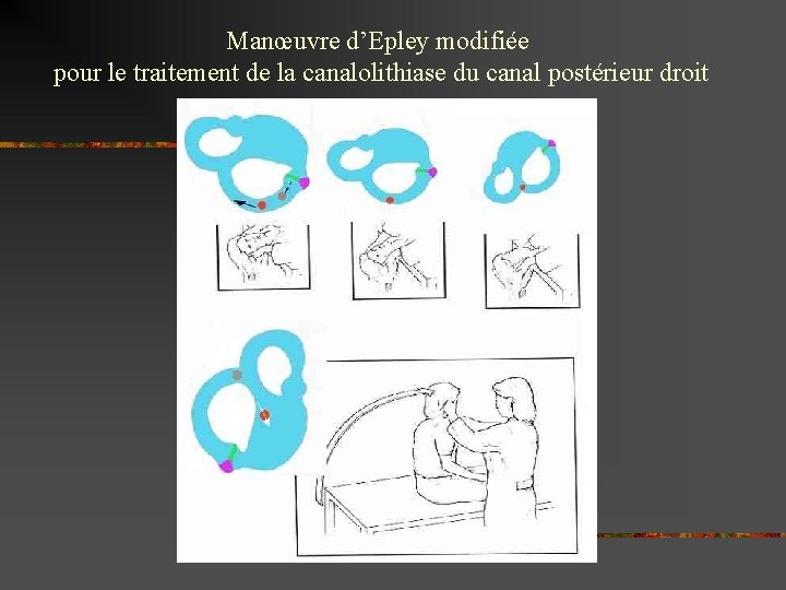 Manœuvre d’Epley modifiée pour le traitement de la canalolithiase du canal postérieur droit 