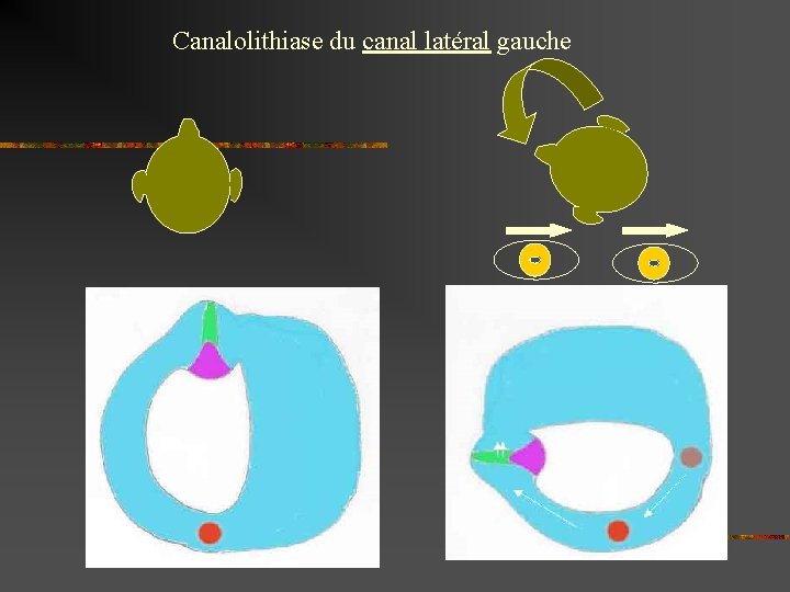 Canalolithiase du canal latéral gauche 
