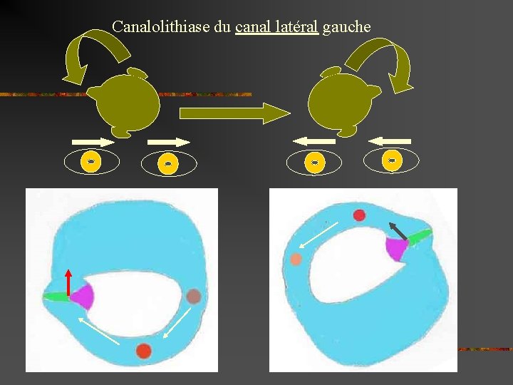 Canalolithiase du canal latéral gauche 