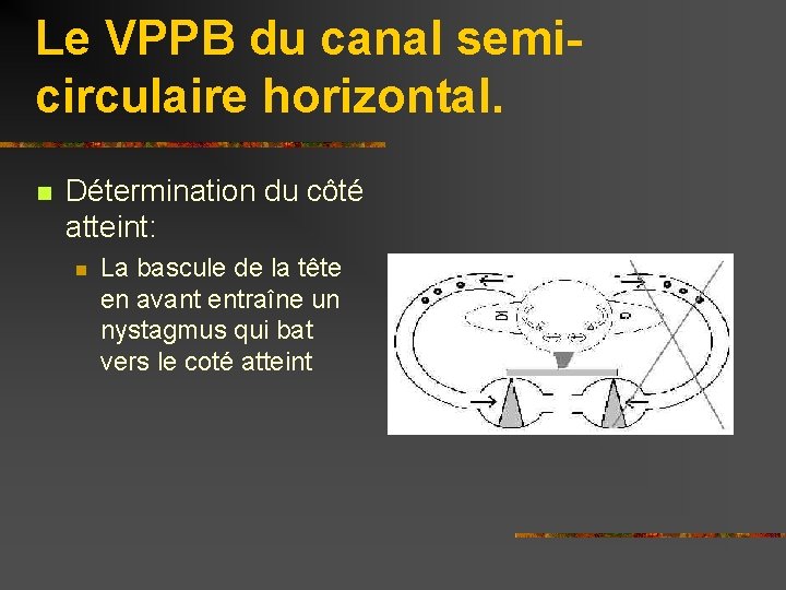 Le VPPB du canal semicirculaire horizontal. n Détermination du côté atteint: n La bascule