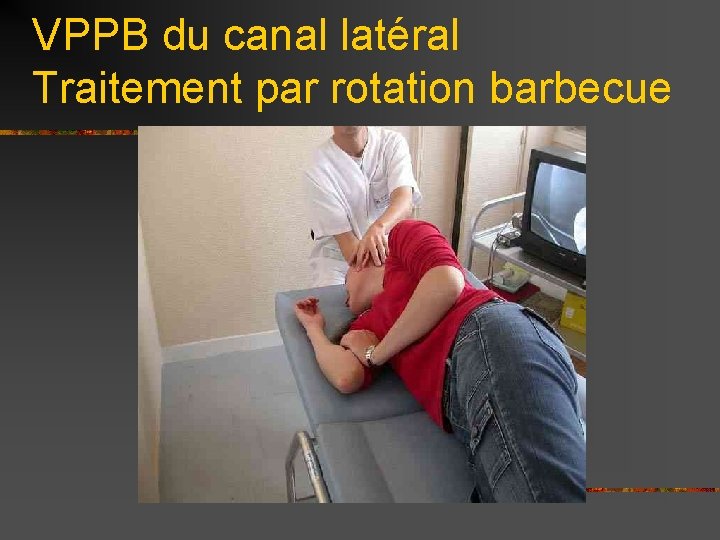 VPPB du canal latéral Traitement par rotation barbecue 