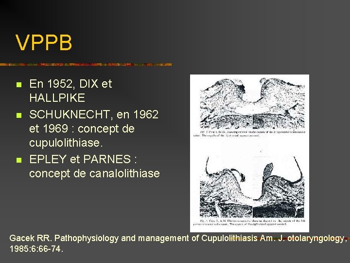 VPPB n n n En 1952, DIX et HALLPIKE SCHUKNECHT, en 1962 et 1969