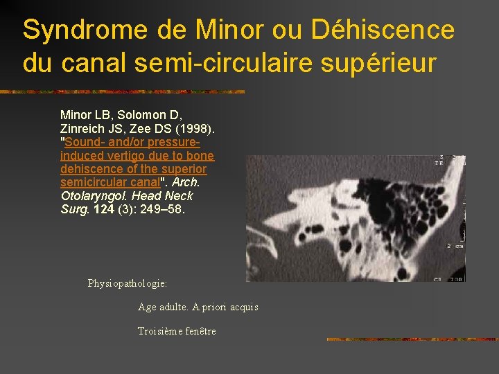 Syndrome de Minor ou Déhiscence du canal semi-circulaire supérieur Minor LB, Solomon D, Zinreich